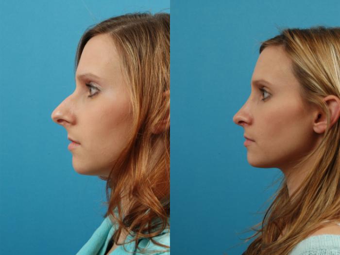 Before & After Rhinoplasty Case 3 View #4 View in West Des Moines & Ames, IA