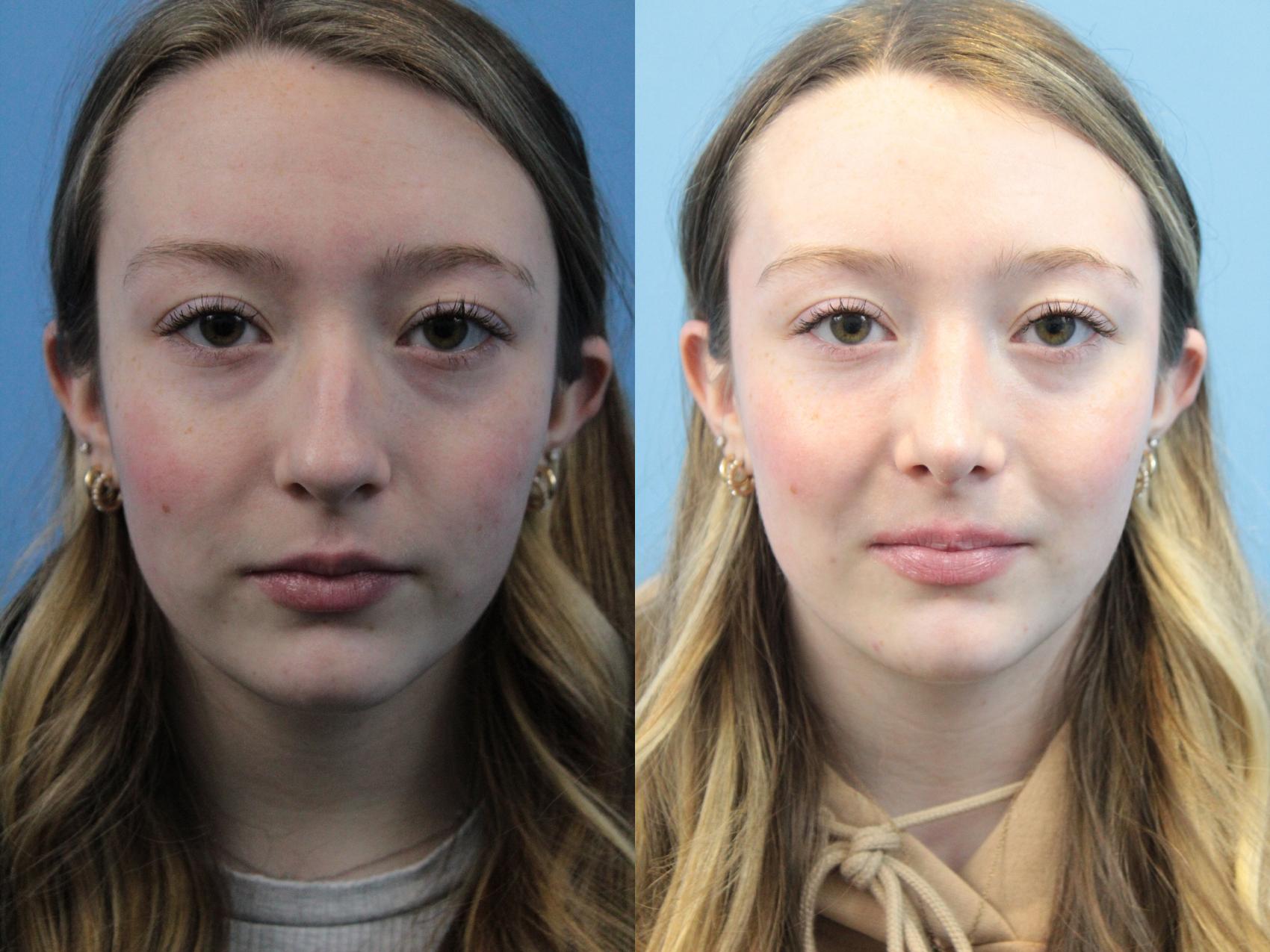 Before & After Rhinoplasty Case 310 Front View in West Des Moines, IA