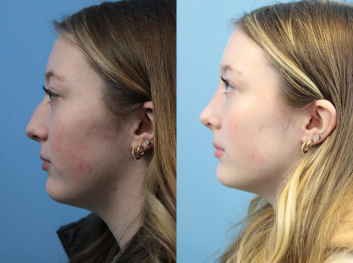Before & After Rhinoplasty Case 310 Left Side View in West Des Moines & Ames, IA