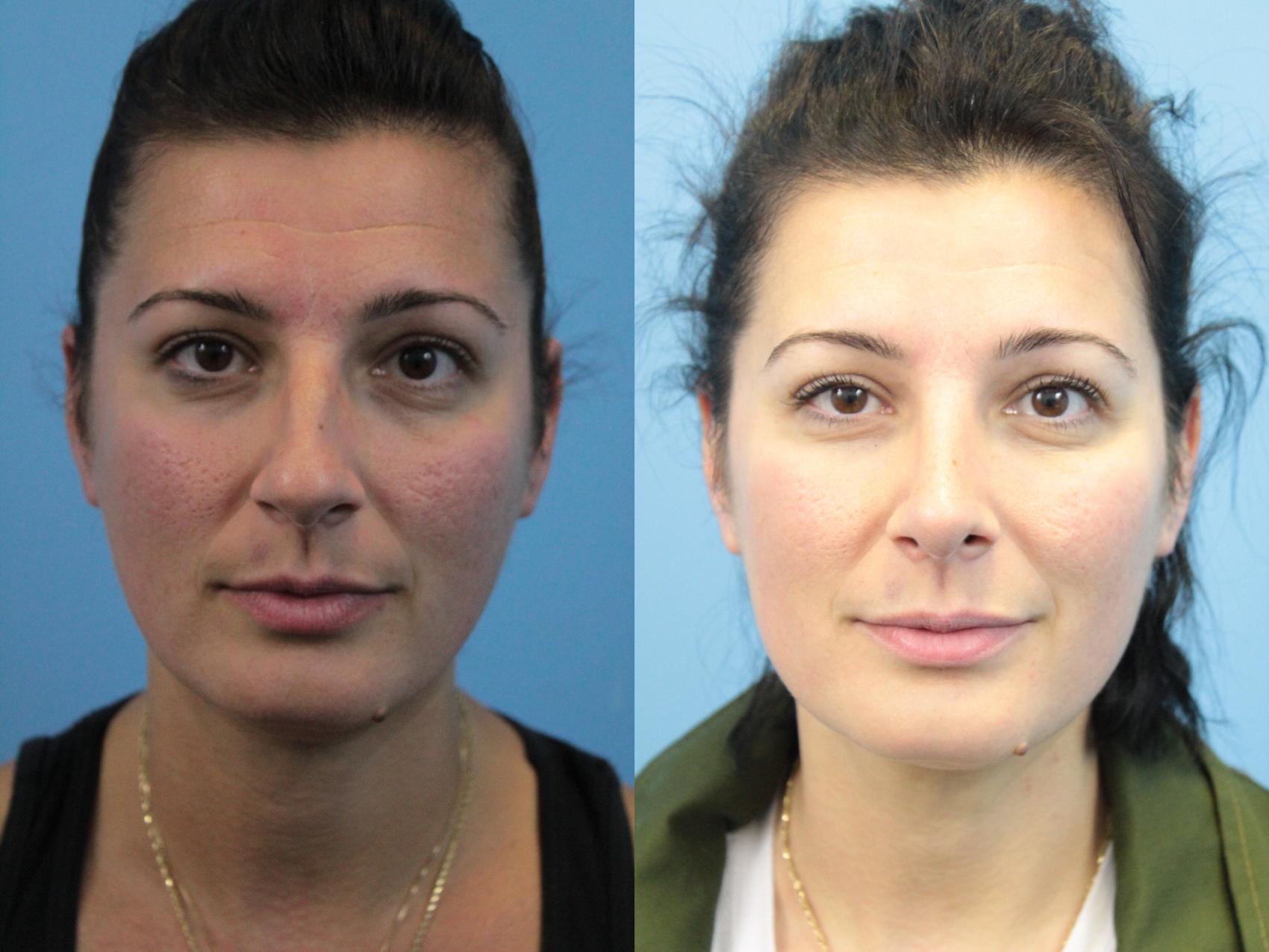 Before & After Rhinoplasty Case 312 Front View in West Des Moines & Ames, IA