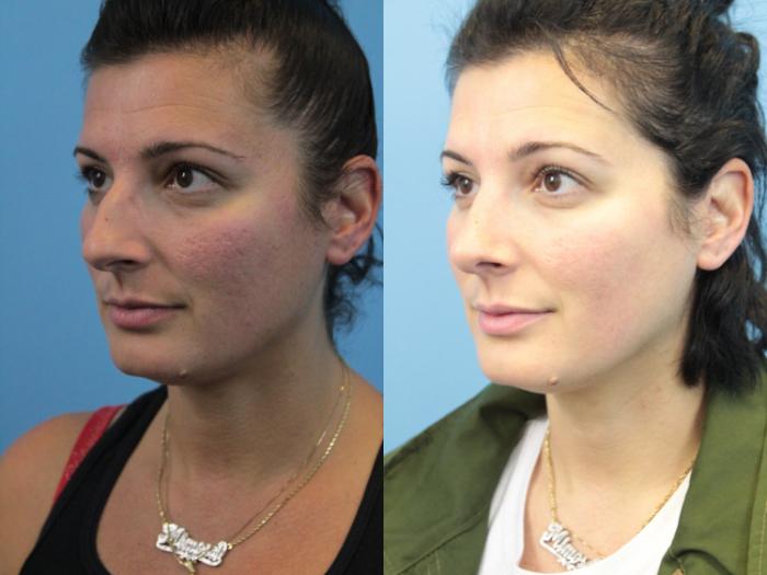 Before & After Rhinoplasty Case 312 Left Oblique View in West Des Moines & Ames, IA