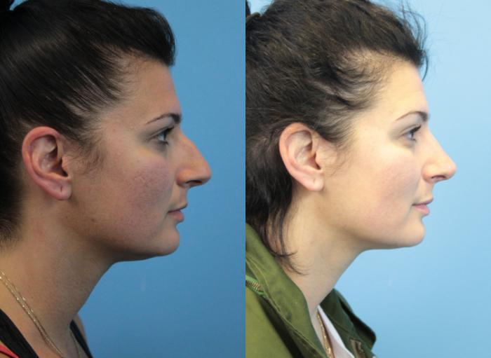 Before & After Rhinoplasty Case 312 Right Side View in West Des Moines & Ames, IA