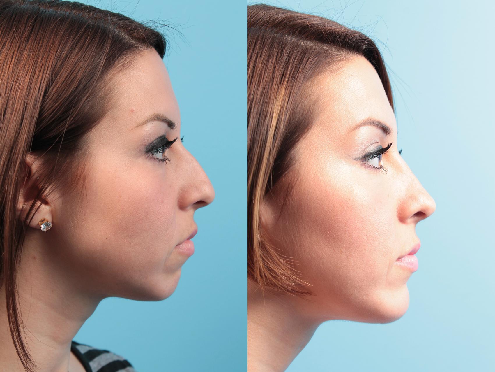 Before & After Rhinoplasty Case 32 View #1 View in West Des Moines, IA