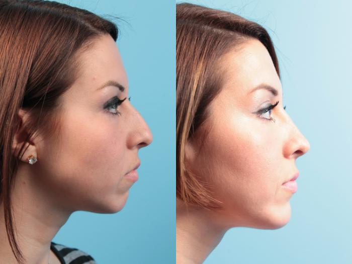 Before & After Rhinoplasty Case 32 View #1 View in West Des Moines & Ames, IA