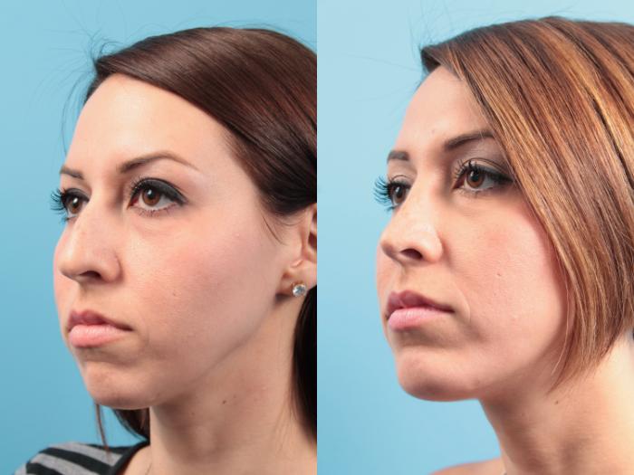 Before & After Chin Augmentation Case 32 View #2 View in West Des Moines & Ames, IA