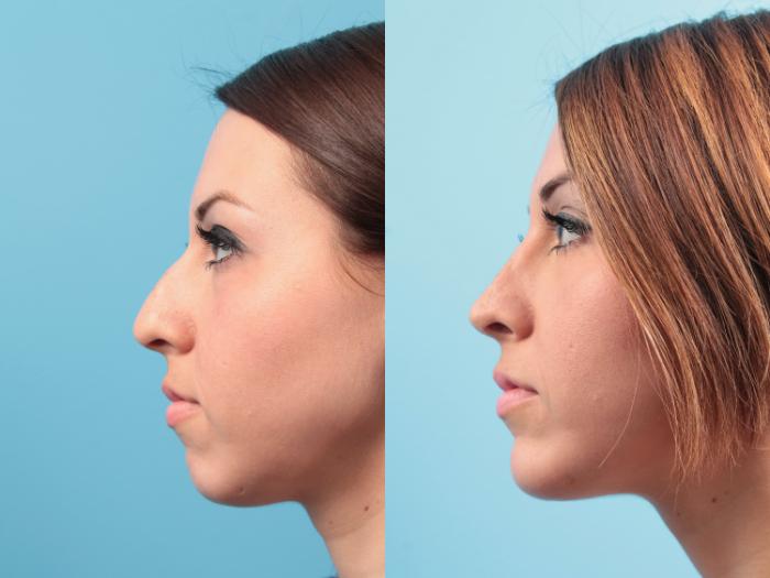 Before & After Rhinoplasty Case 32 View #3 View in West Des Moines & Ames, IA