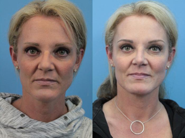 Before & After Rhinoplasty Case 330 Front View in West Des Moines & Ames, IA