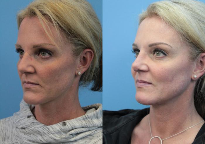 Before & After Rhinoplasty Case 330 Left Oblique View in West Des Moines & Ames, IA