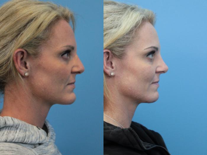 Before & After Rhinoplasty Case 330 Right Side View in West Des Moines & Ames, IA