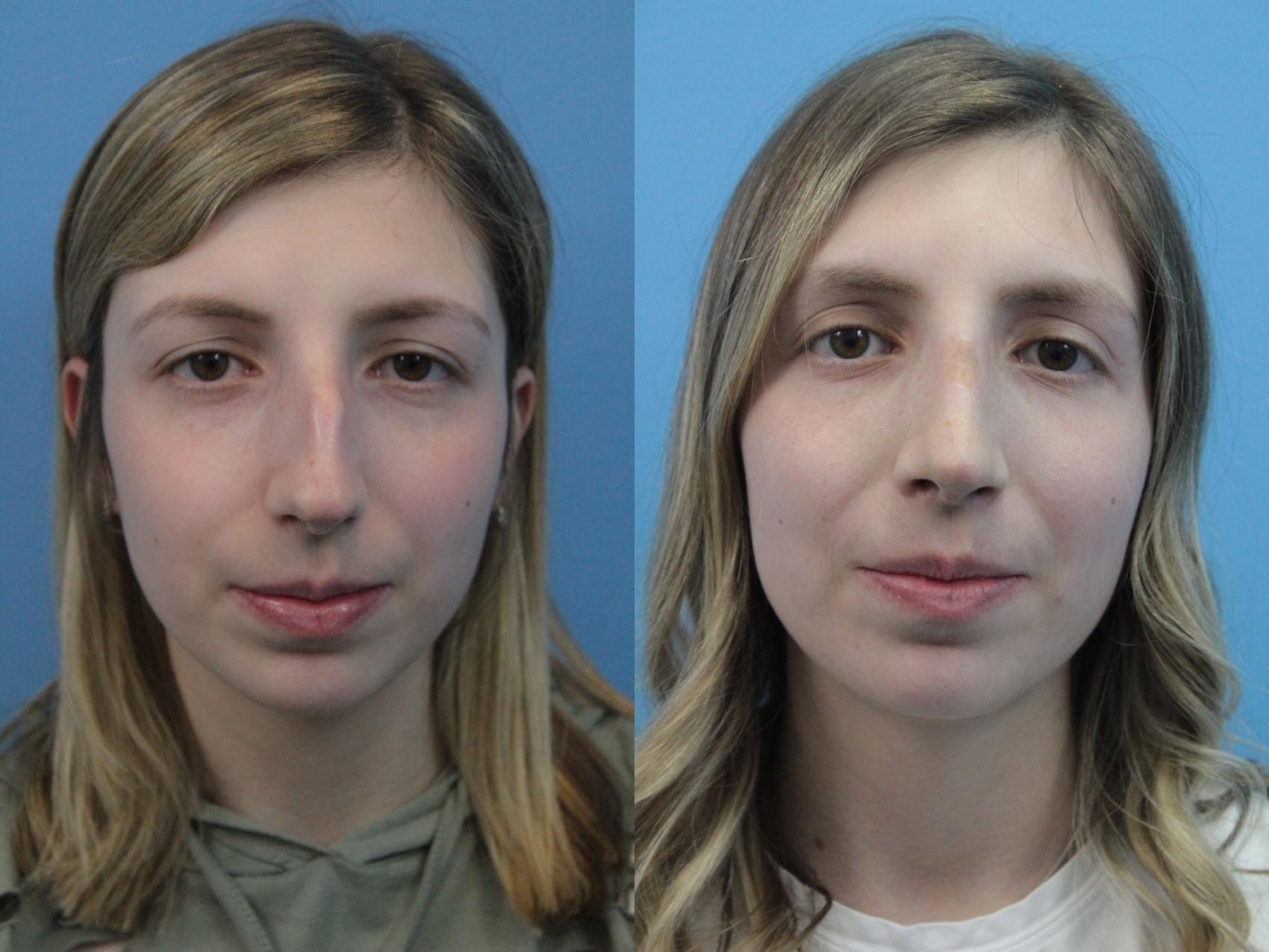 Before & After Rhinoplasty Case 398 Front View in West Des Moines & Ames, IA