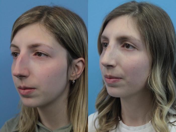Before & After Rhinoplasty Case 398 Left Oblique View in West Des Moines & Ames, IA