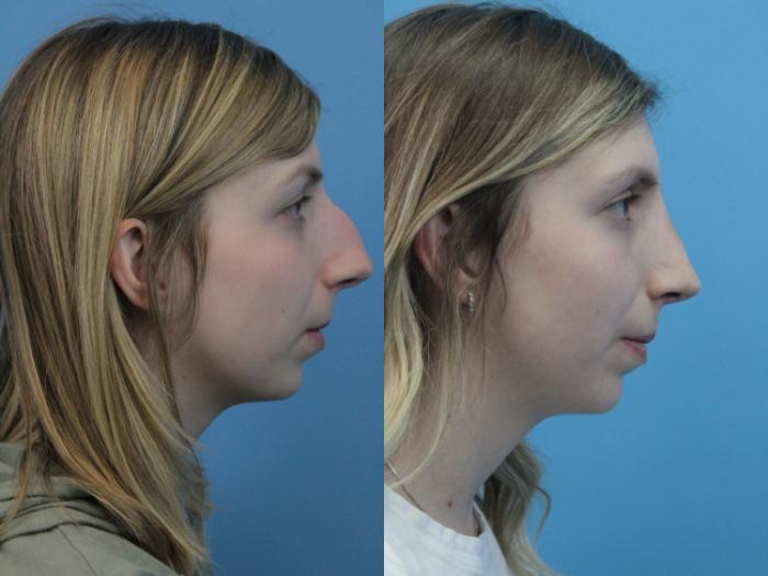 Before & After Rhinoplasty Case 398 Right Side View in West Des Moines & Ames, IA