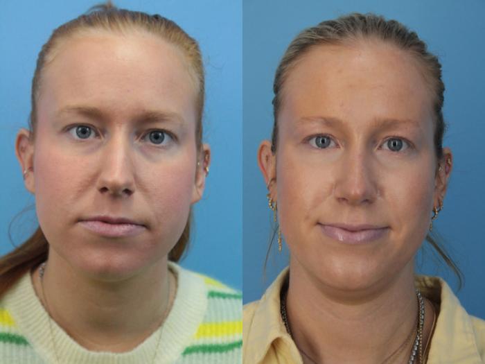 Before & After Rhinoplasty Case 399 Front View in West Des Moines & Ames, IA
