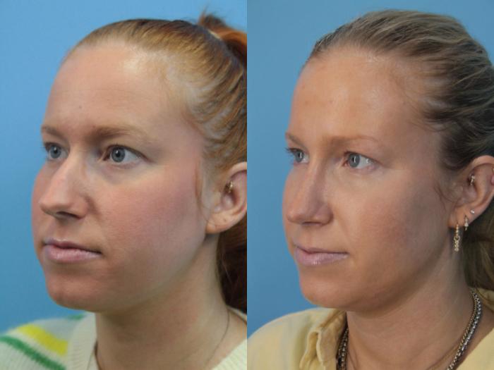 Before & After Rhinoplasty Case 399 Left Oblique View in West Des Moines & Ames, IA