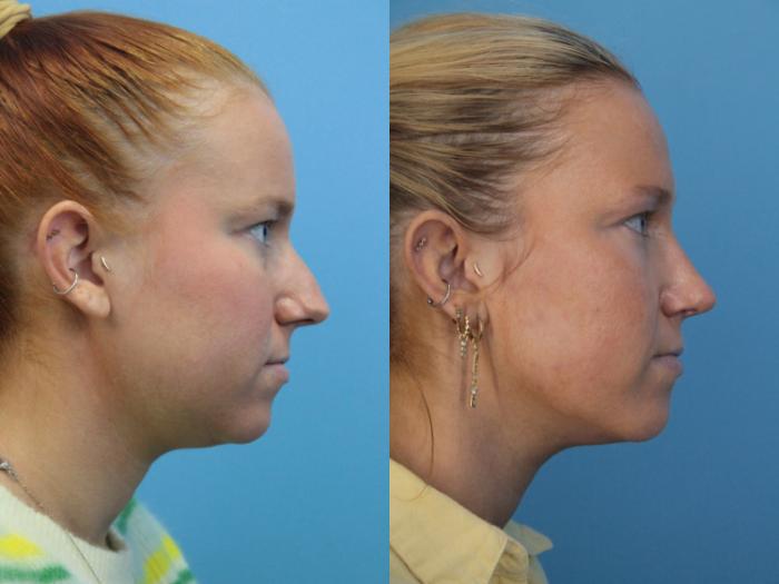 Before & After Rhinoplasty Case 399 Right Side View in West Des Moines & Ames, IA