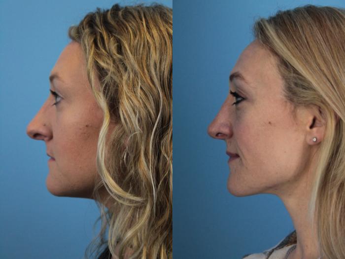 Before & After Rhinoplasty Case 402 Left Side View in West Des Moines & Ames, IA