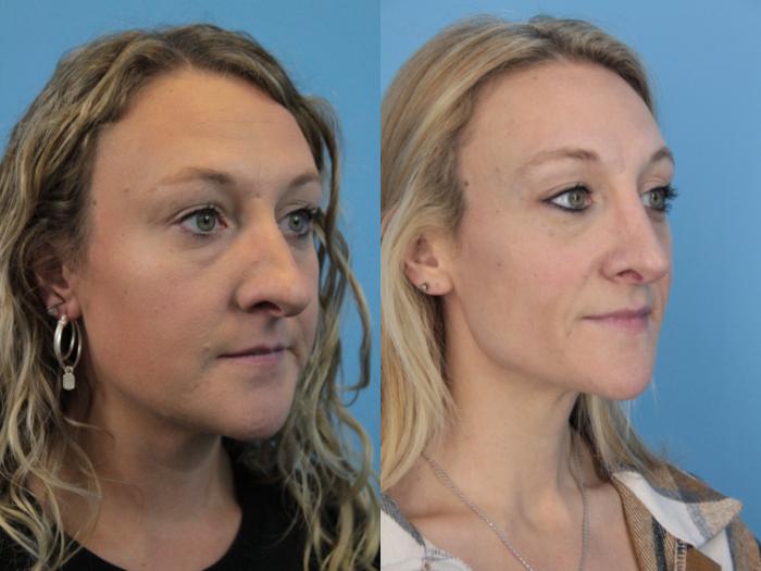 Before & After Rhinoplasty Case 402 Right Oblique View in West Des Moines & Ames, IA