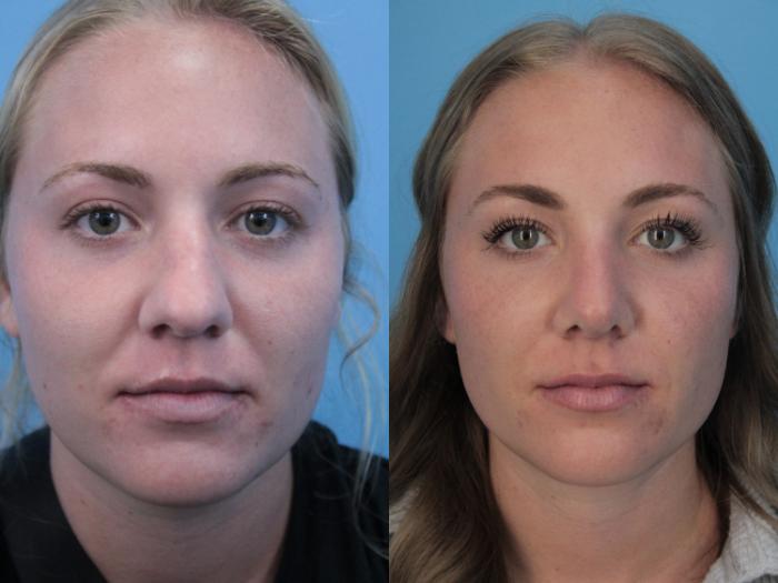 Before & After Rhinoplasty Case 403 Front View in West Des Moines & Ames, IA