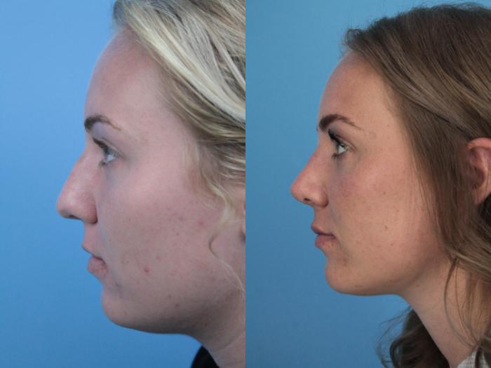 Before & After Rhinoplasty Case 403 Left Side View in West Des Moines & Ames, IA