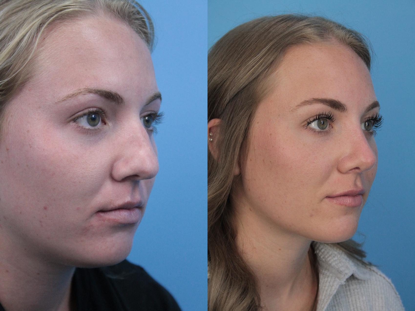 Before & After Rhinoplasty Case 403 Right Oblique View in West Des Moines & Ames, IA