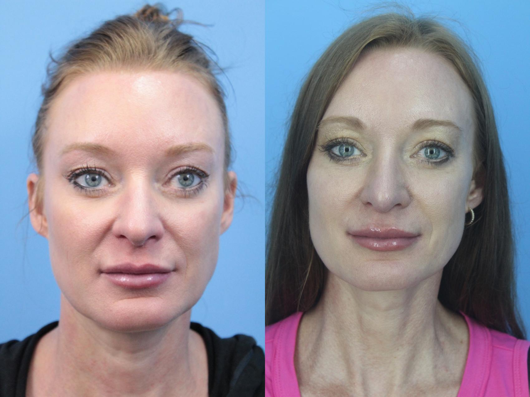 Before & After Rhinoplasty Case 430 Front View in West Des Moines & Ames, IA