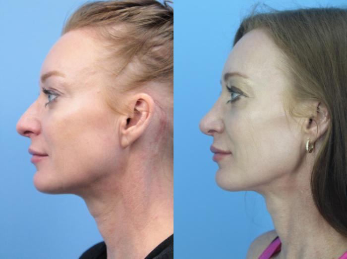 Before & After Rhinoplasty Case 430 Left Side View in West Des Moines & Ames, IA