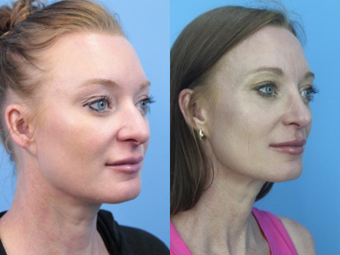 Before & After Rhinoplasty Case 430 Right Oblique View in West Des Moines & Ames, IA