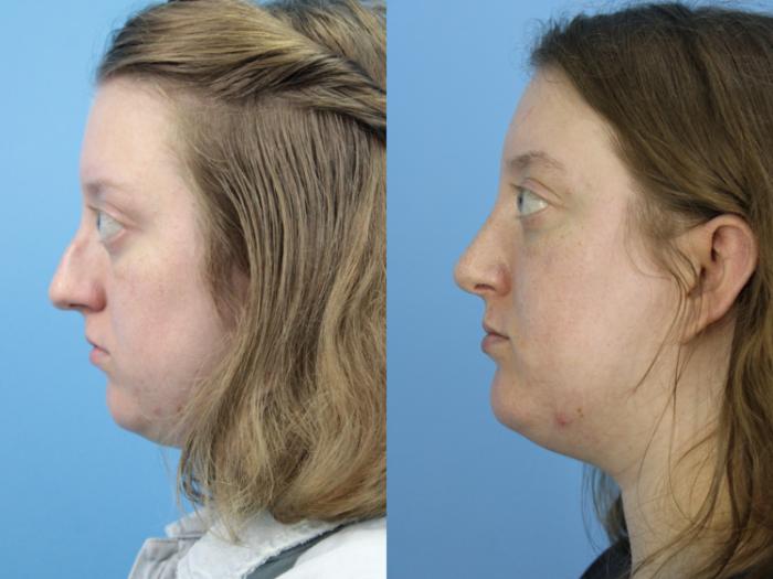 Before & After Rhinoplasty Case 444 Left Side View in West Des Moines & Ames, IA