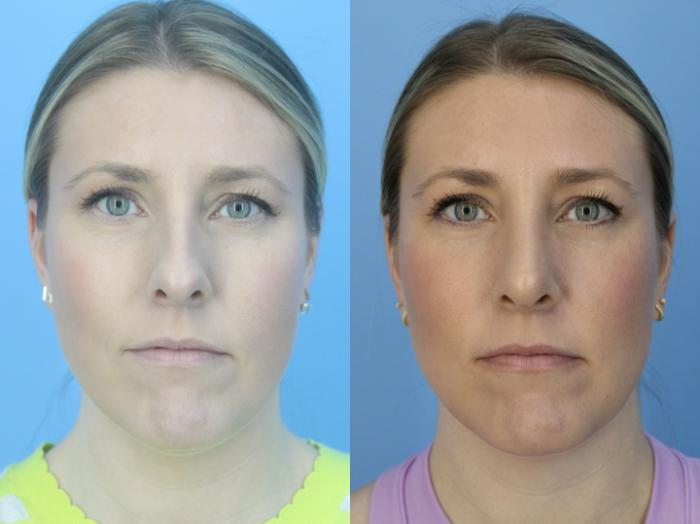 Before & After Rhinoplasty Case 446 Front View in West Des Moines & Ames, IA