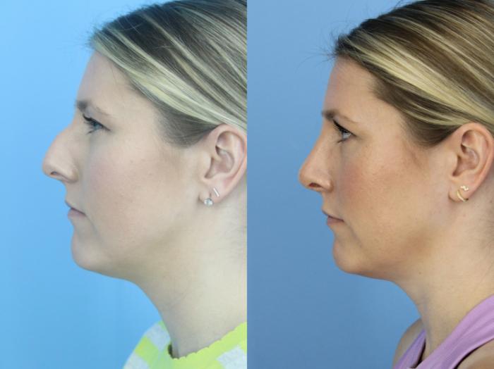 Before & After Rhinoplasty Case 446 Left Side View in West Des Moines & Ames, IA