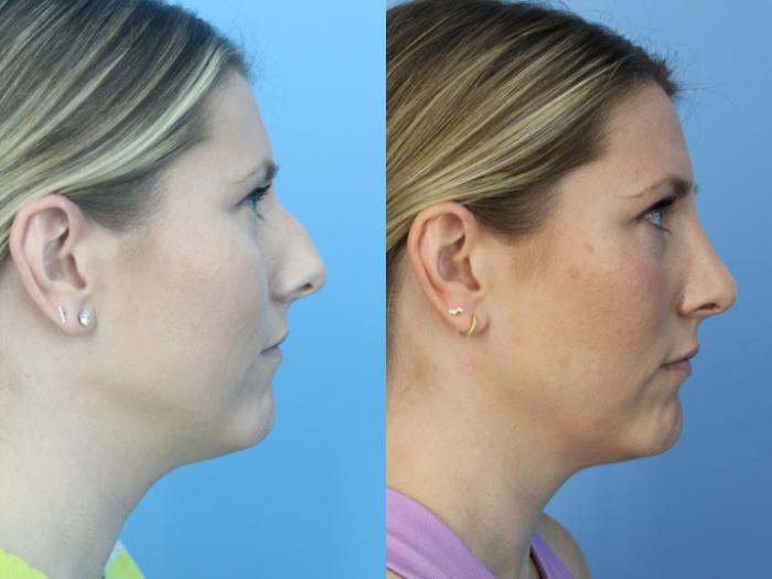 Before & After Rhinoplasty Case 446 Right Side View in West Des Moines & Ames, IA