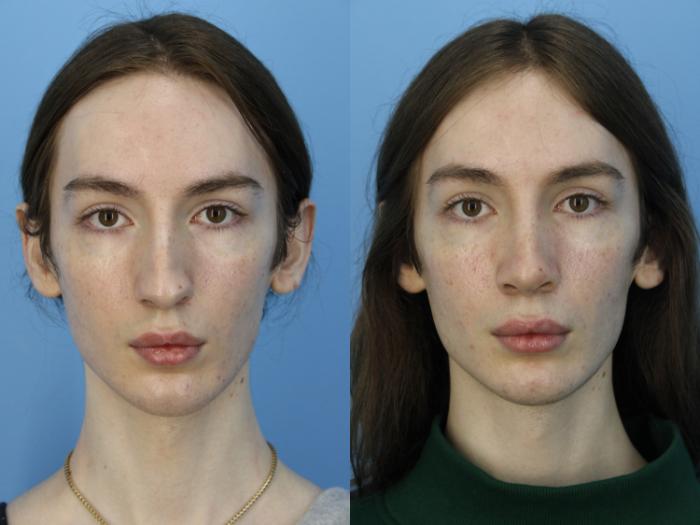 Before & After Rhinoplasty Case 475 Front View in West Des Moines & Ames, IA