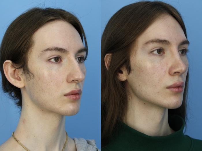 Before & After Rhinoplasty Case 475 Right Oblique View in West Des Moines & Ames, IA