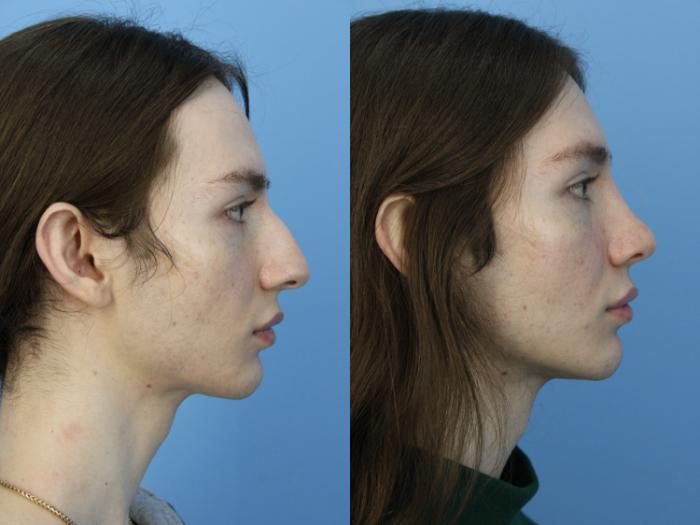 Before & After Rhinoplasty Case 475 Right Side View in West Des Moines & Ames, IA