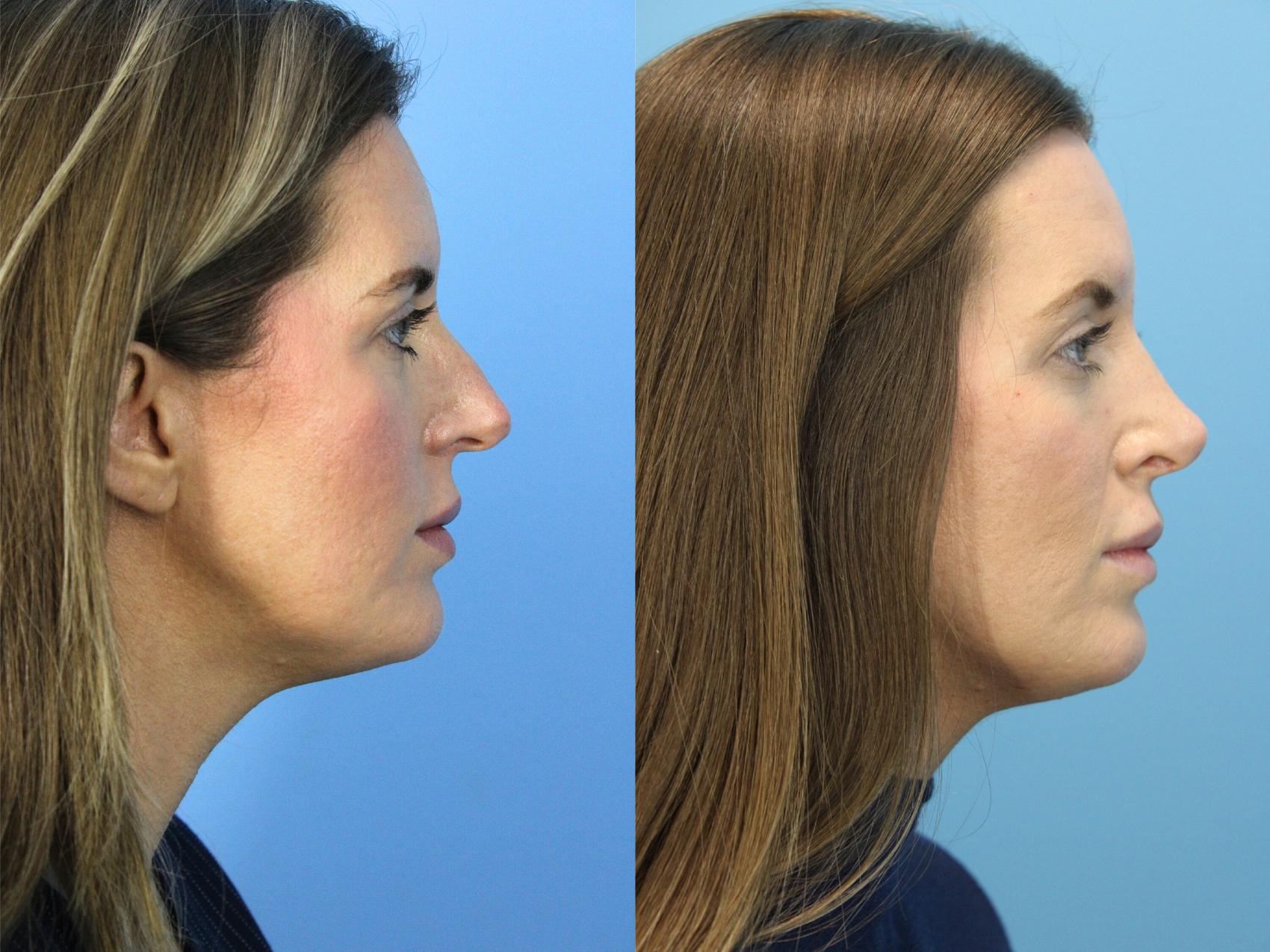 Before & After Rhinoplasty Case 501 Right Side View in West Des Moines & Ames, IA