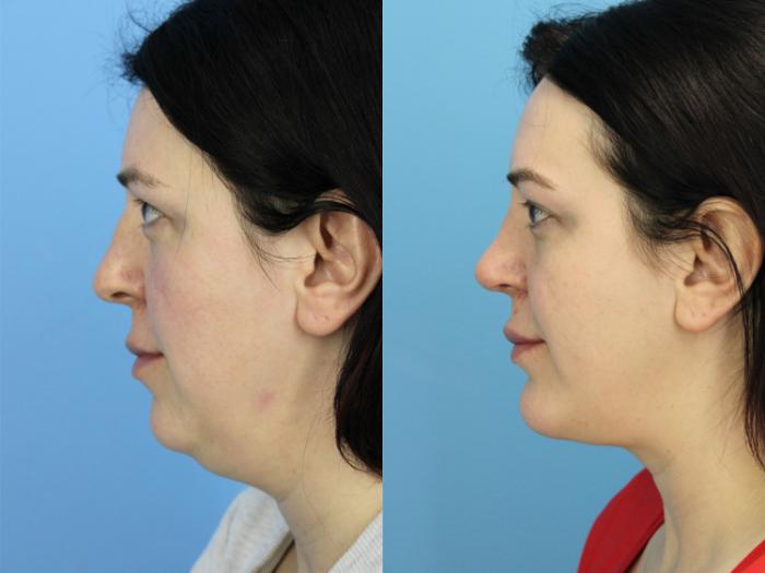 Before & After Chin Augmentation Case 509 Left Side View in West Des Moines & Ames, IA