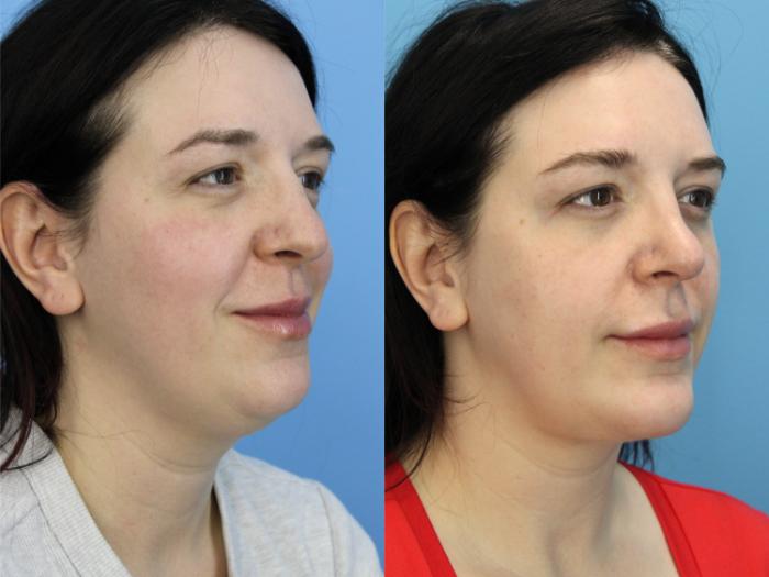 Before & After Rhinoplasty Case 509 Right Oblique View in West Des Moines & Ames, IA