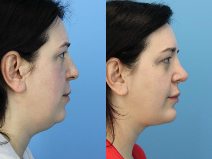 Before & After Rhinoplasty Case 509 Right Side View in West Des Moines & Ames, IA