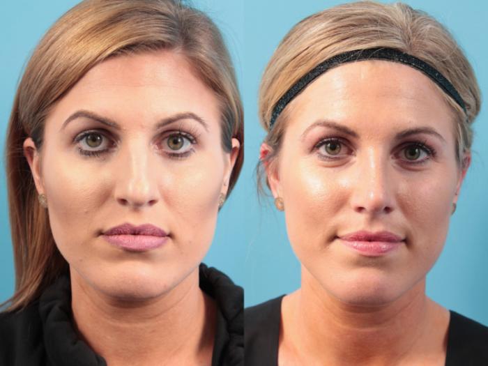 Before & After Rhinoplasty Case 53 Front View in West Des Moines & Ames, IA