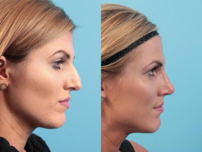 Before & After Rhinoplasty Case 53 Right Side View in West Des Moines & Ames, IA