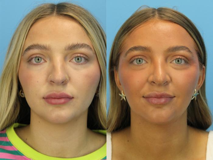 Before & After Rhinoplasty Case 551 Front View in West Des Moines & Ames, IA