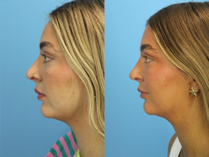 Before & After Rhinoplasty Case 551 Left Side View in West Des Moines & Ames, IA