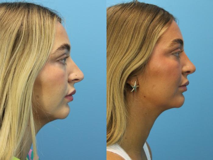 Before & After Rhinoplasty Case 551 Right Side View in West Des Moines & Ames, IA