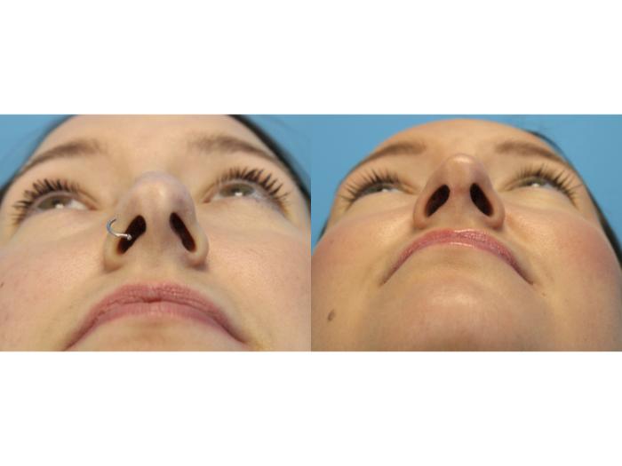 Before & After Rhinoplasty Case 567 Close Up View in West Des Moines & Ames, IA