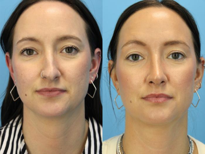 Before & After Rhinoplasty Case 567 Front View in West Des Moines & Ames, IA