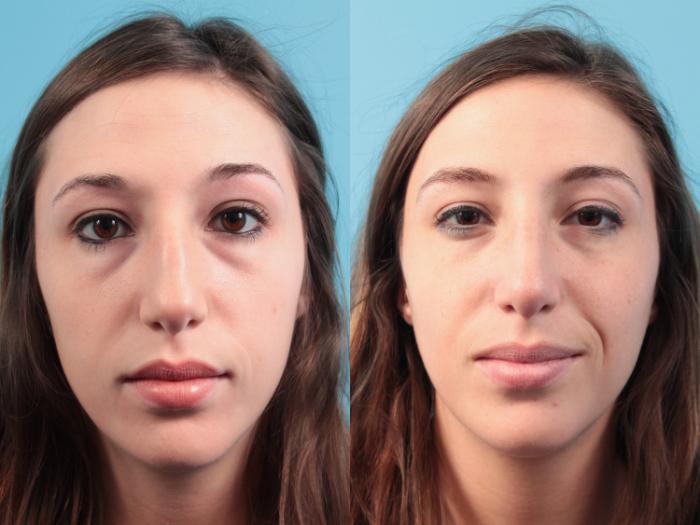 Before & After Rhinoplasty Case 58 View #1 View in West Des Moines & Ames, IA