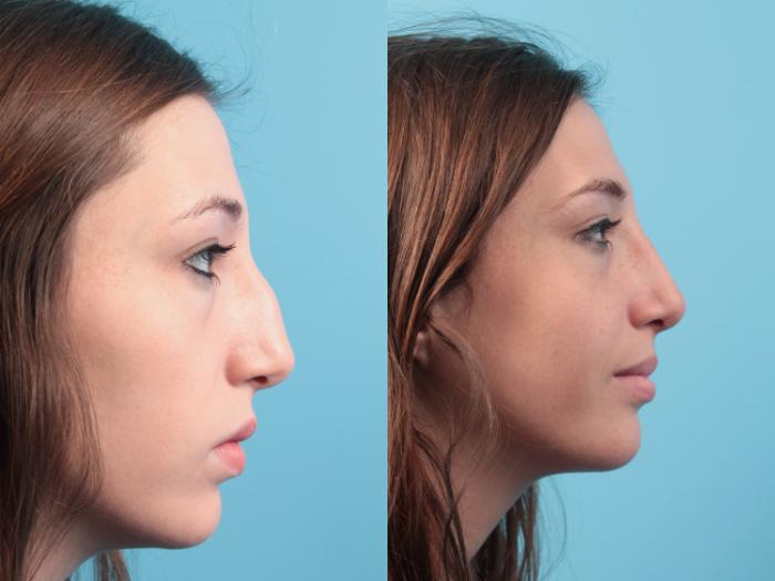 Before & After Rhinoplasty Case 58 View #2 View in West Des Moines & Ames, IA