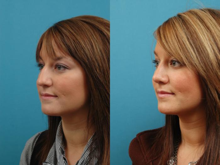 Before & After Rhinoplasty Case 6 Left Oblique View in West Des Moines & Ames, IA