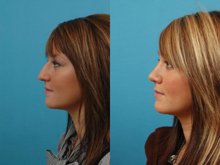 Before & After Rhinoplasty Case 6 Left Side View in West Des Moines & Ames, IA