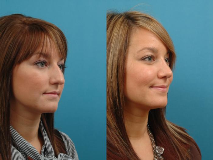 Before & After Rhinoplasty Case 6 Right Oblique View in West Des Moines & Ames, IA